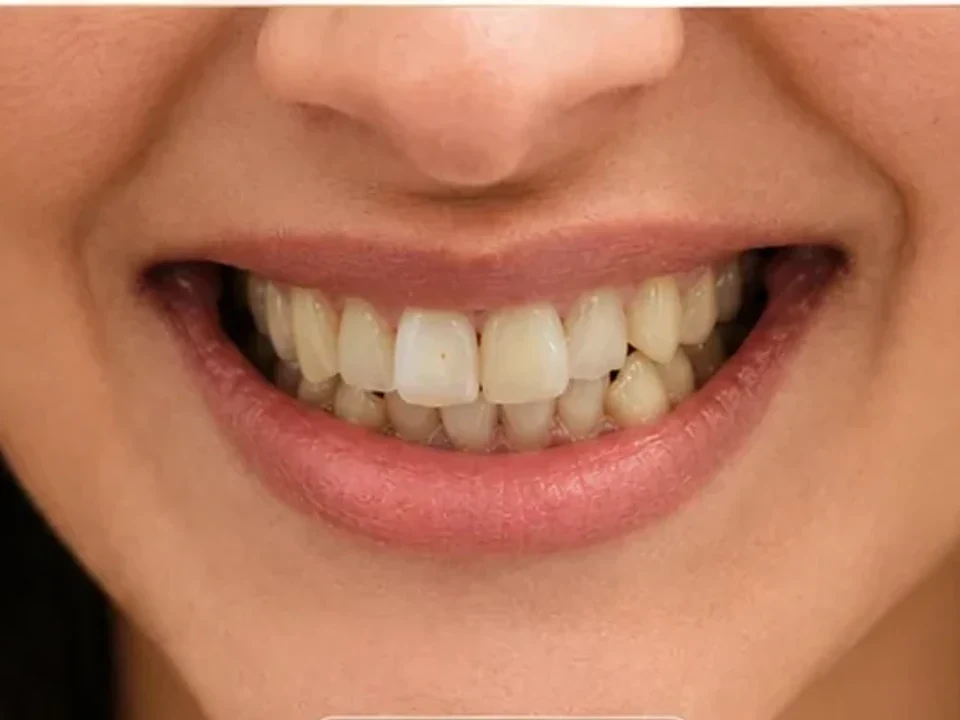 Smile makeover excellence — crooked, greyish teeth to a Hollywood smile — before