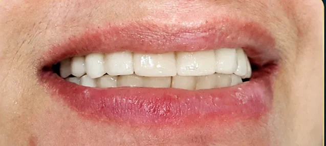 Smile transformation with same-day implants — after