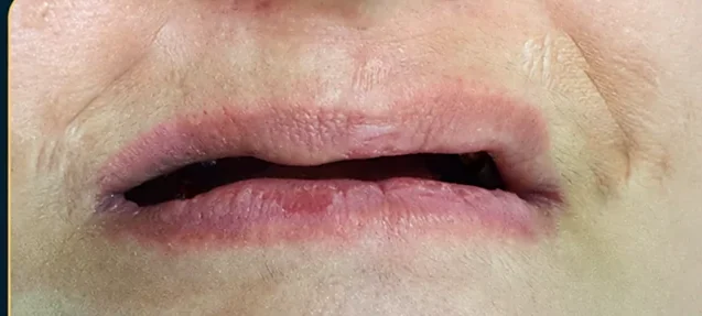 Smile transformation with same-day implants — before