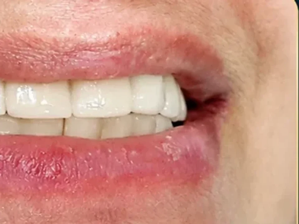 Smile transformation with same-day implants — after