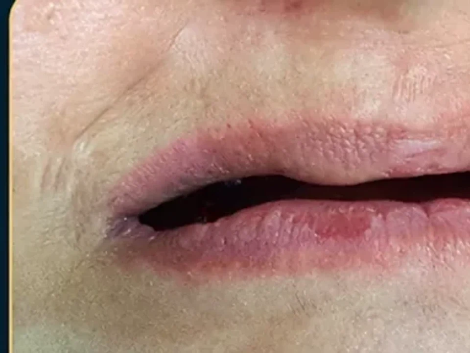 Smile transformation with same-day implants — before