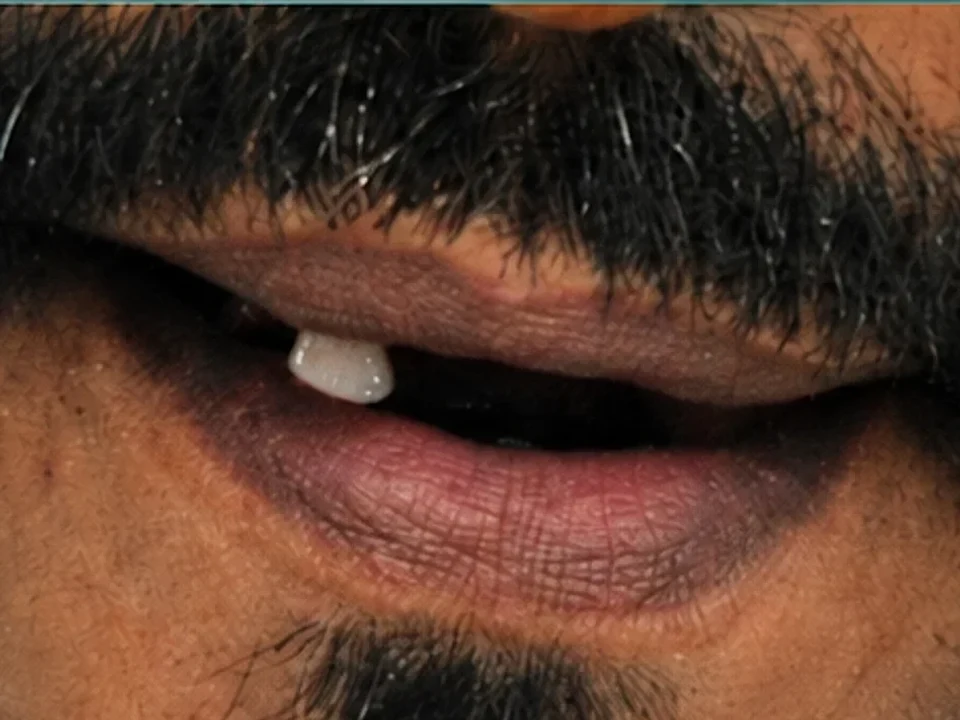 Missing teeth replaced with same-day implants — before
