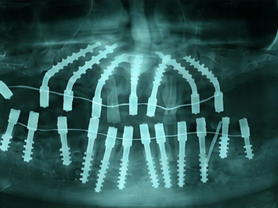 Teeth in a Day — panoramic X-ray — after