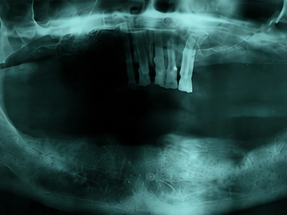 Teeth in a Day — panoramic X-ray — before