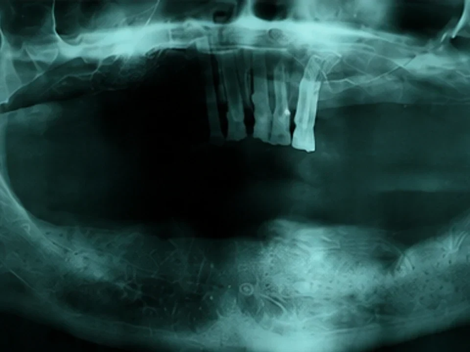 Teeth in a Day — panoramic X-ray — before