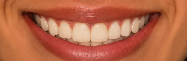 Whitening — before and after — after