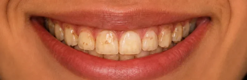 Whitening — before and after — before