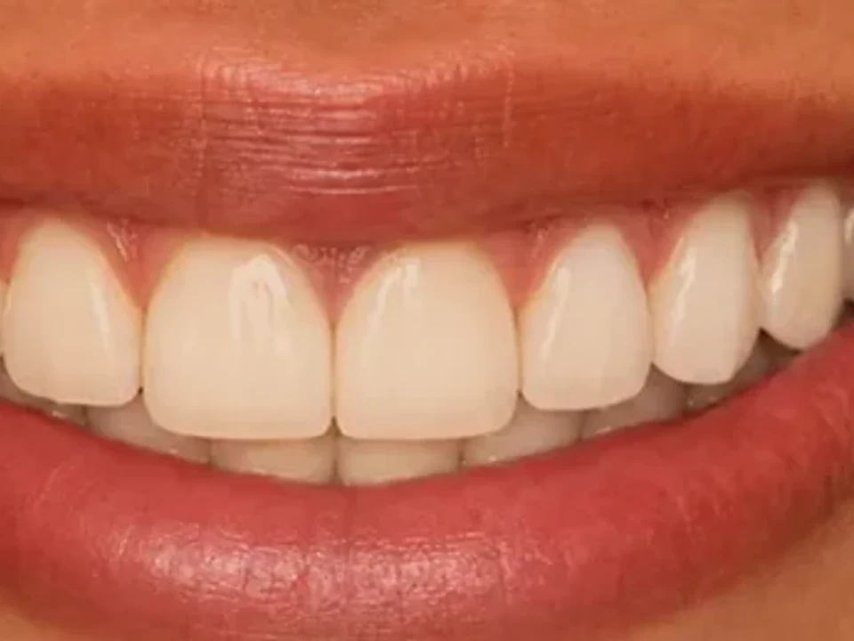 Whitening — before and after — after