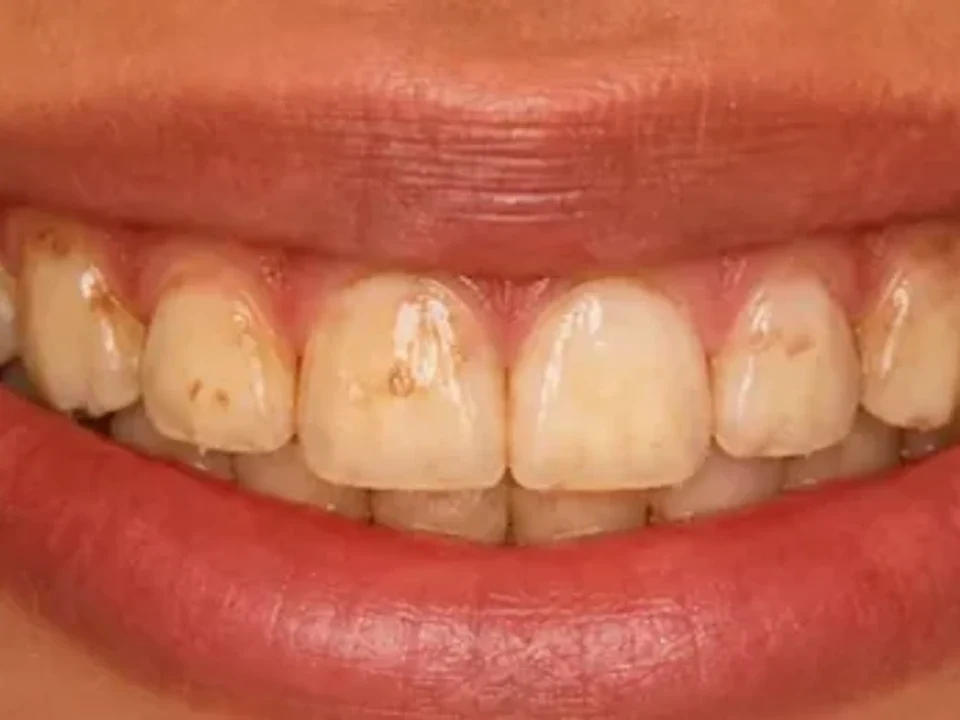Whitening — before and after — before