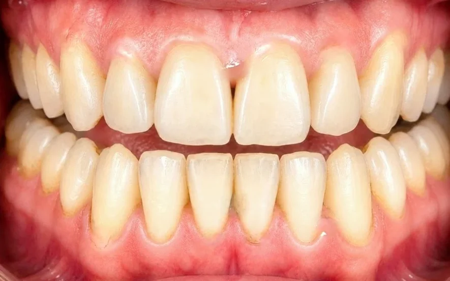 Professional whitening — stained to bright — after