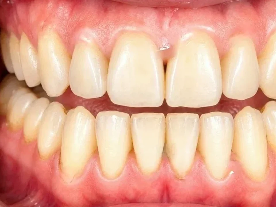 Professional whitening — stained to bright — after