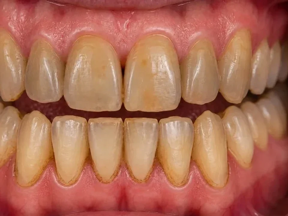 Professional whitening — stained to bright — before
