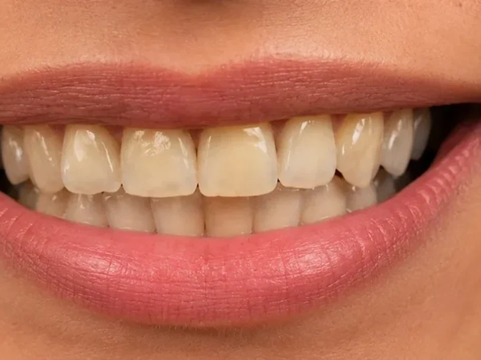 Whitening — smile close-up — before
