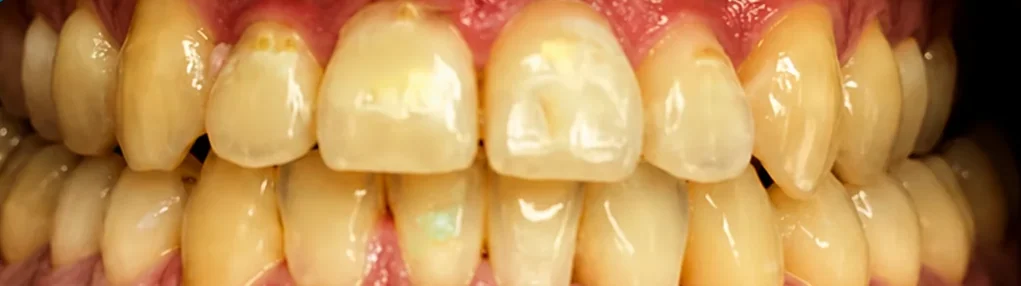 Teeth whitening at the QDC — before