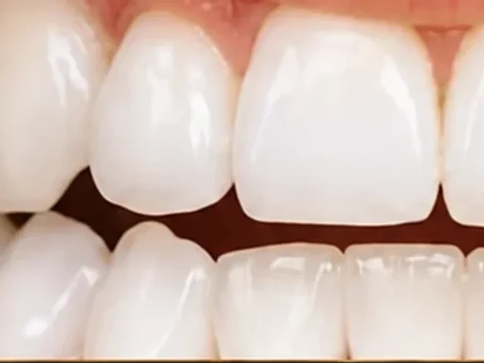 Teeth whitening at the QDC — after