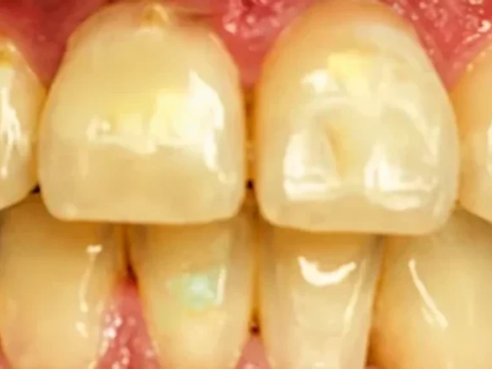 Teeth whitening at the QDC — before