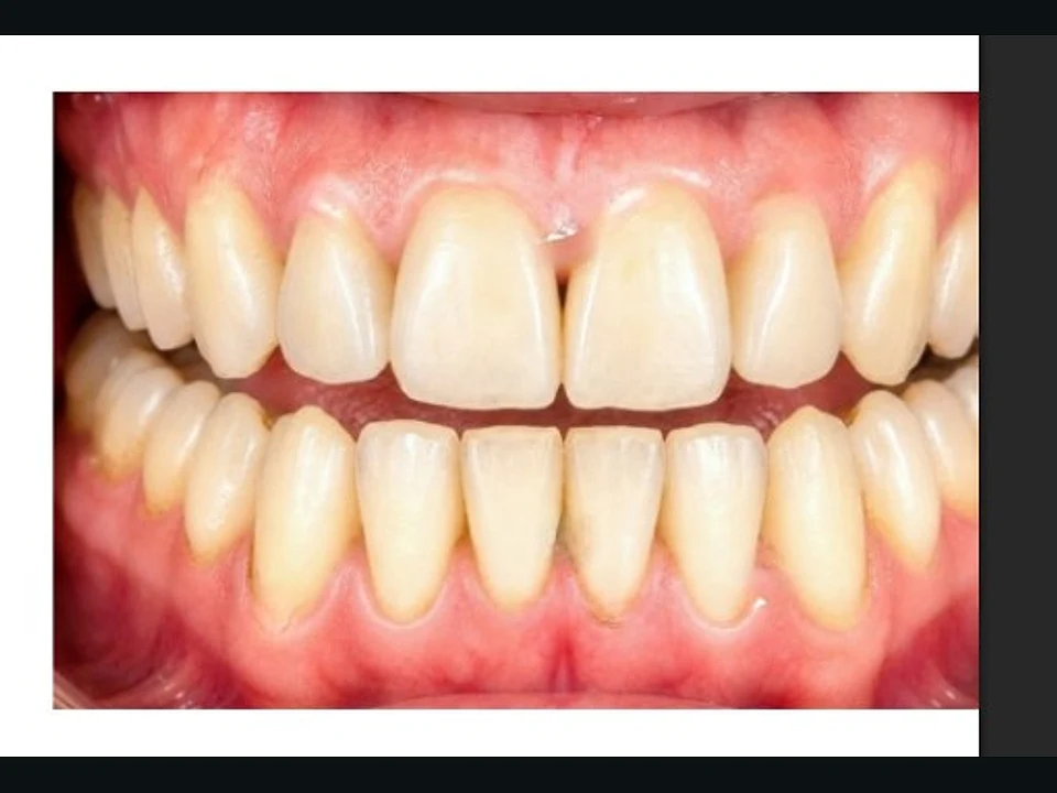 Heavy staining cleared — bright, even teeth — after