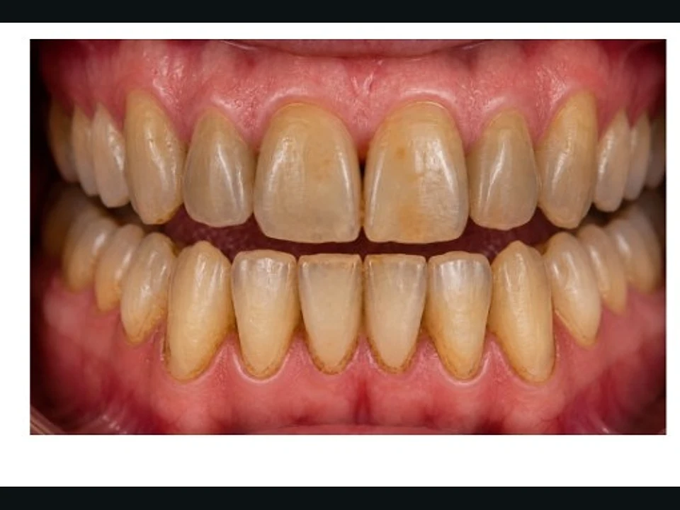 Heavy staining cleared — bright, even teeth — before
