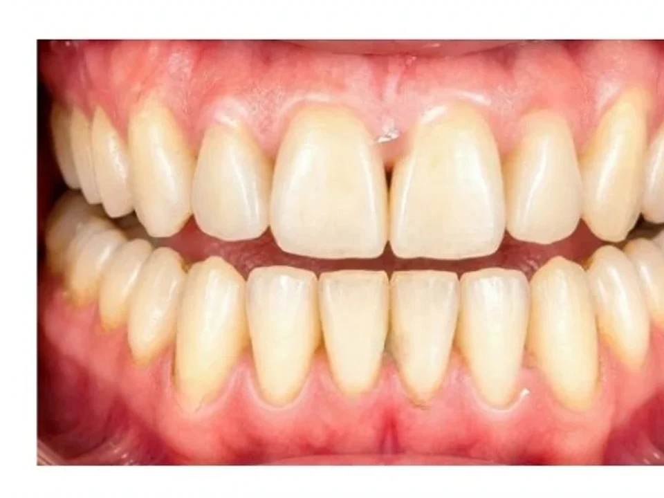 Heavy staining cleared — bright, even teeth — after