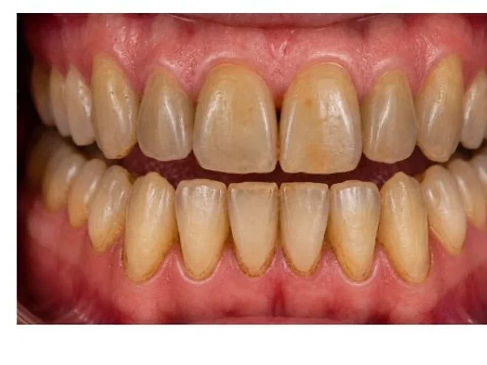 Heavy staining cleared — bright, even teeth — before