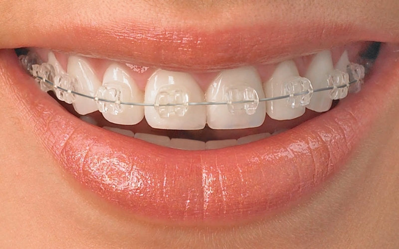 Ceramic Braces