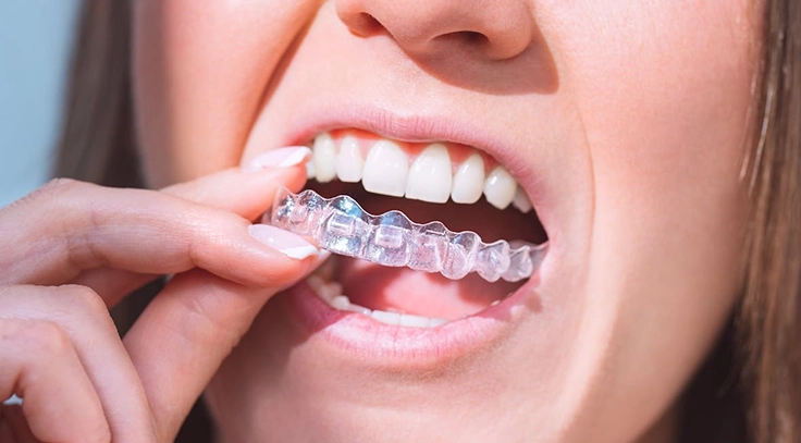 Invisible Braces in Lahore