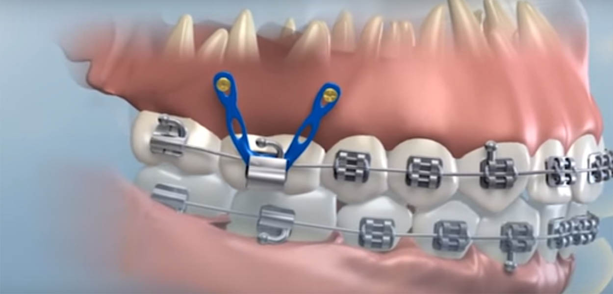 Orthodontic Micro-Implants (TADs)