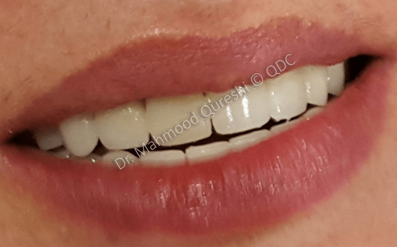After Treatment