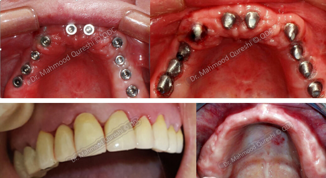 Full Mouth Reconstructive Surgery
