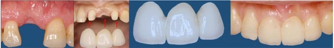 Full Mouth Reconstructive Surgery