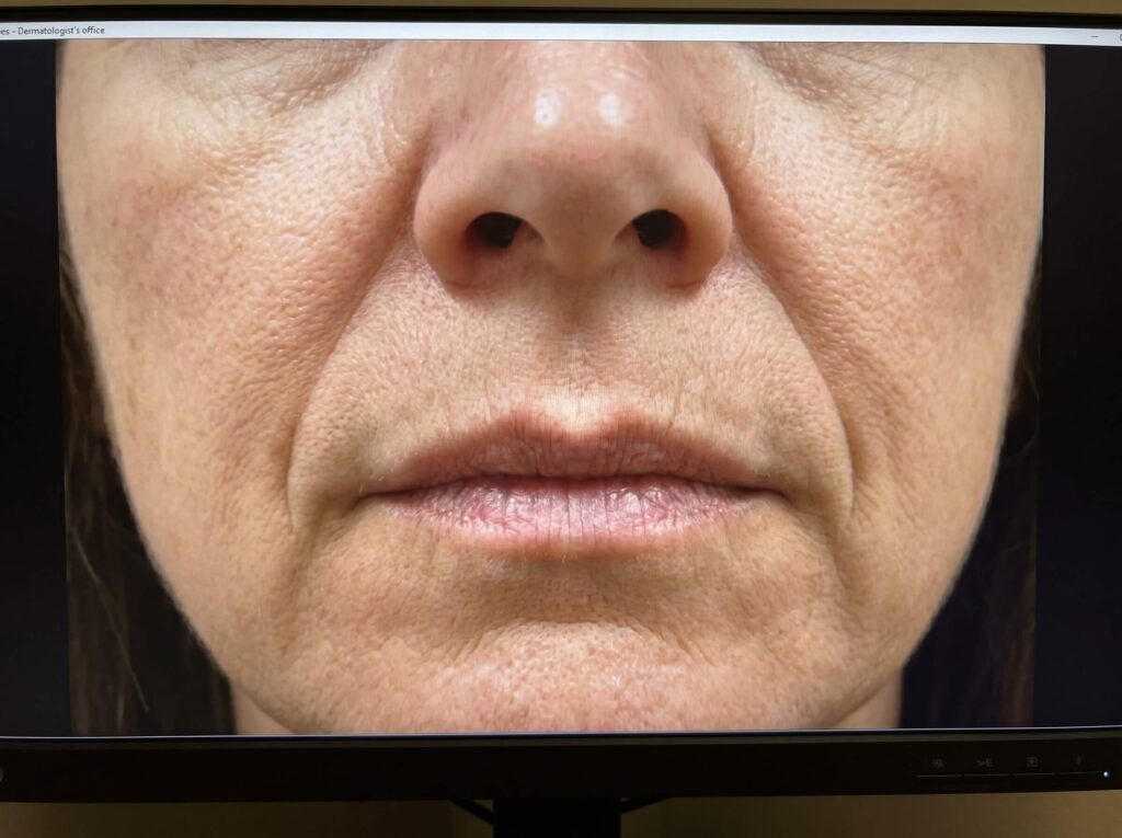 Nasolabial Folds