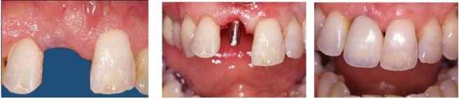 Full Mouth Reconstructive Surgery