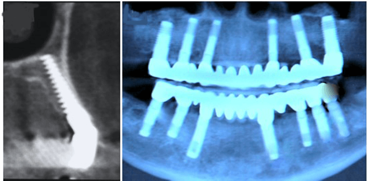 Sinus Lift (Sinus Augmentation)