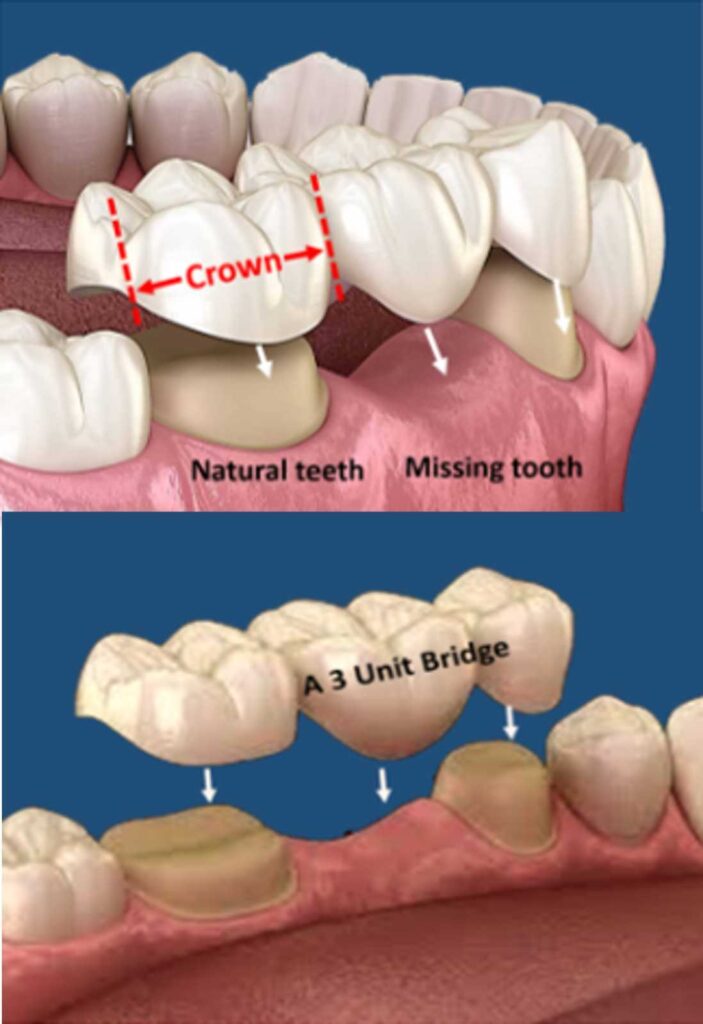 What Is a Dental Bridge